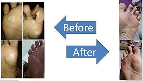 Foot corn treatment in ayurveda outlet
